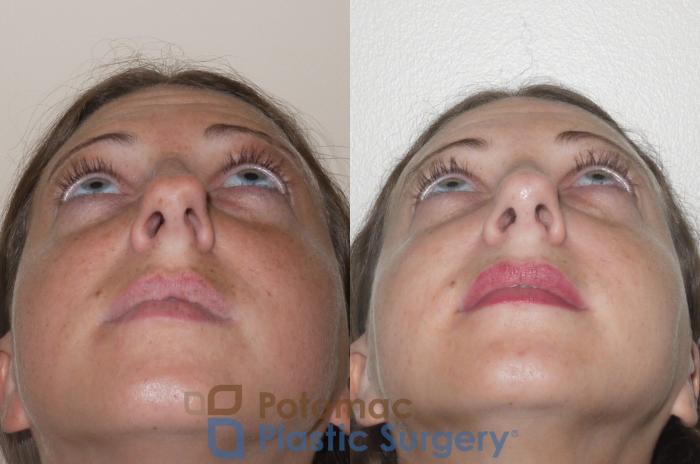 Before & After Rhinoplasty - Medical Case 64 Below View in Washington, DC