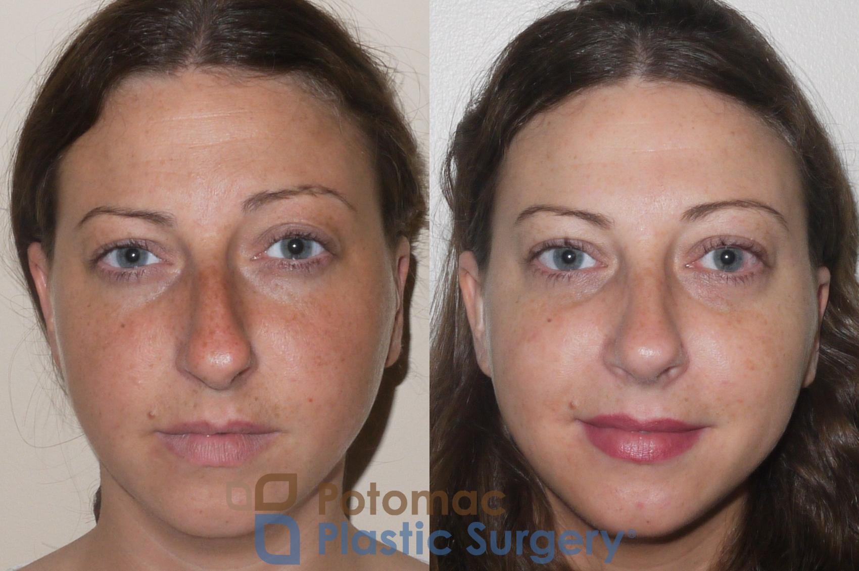 Before & After Rhinoplasty - Medical Case 64 Front View in Washington, DC