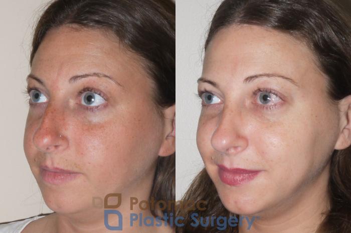 Before & After Rhinoplasty - Cosmetic Case 64 Left Oblique View in Washington DC & Arlington , DC