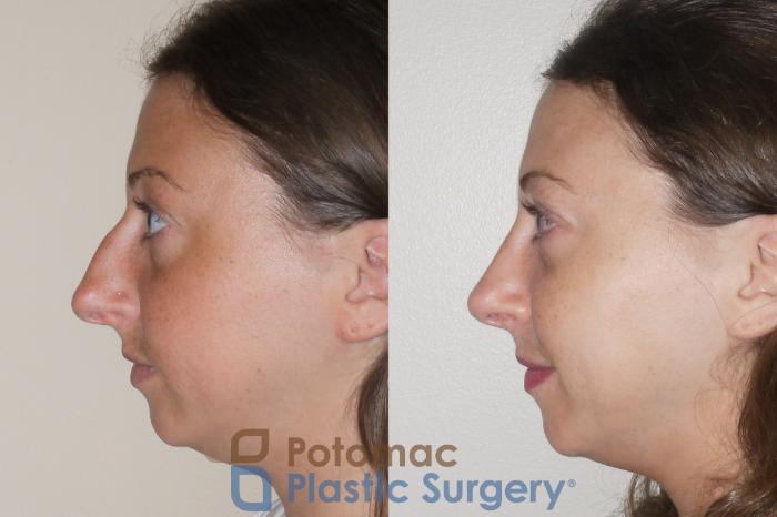 Before & After Rhinoplasty - Cosmetic Case 64 Left Side View in Washington DC & Arlington , DC