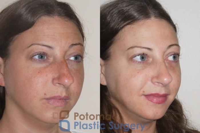 Before & After Rhinoplasty - Cosmetic Case 64 Right Oblique View in Washington DC & Arlington , DC