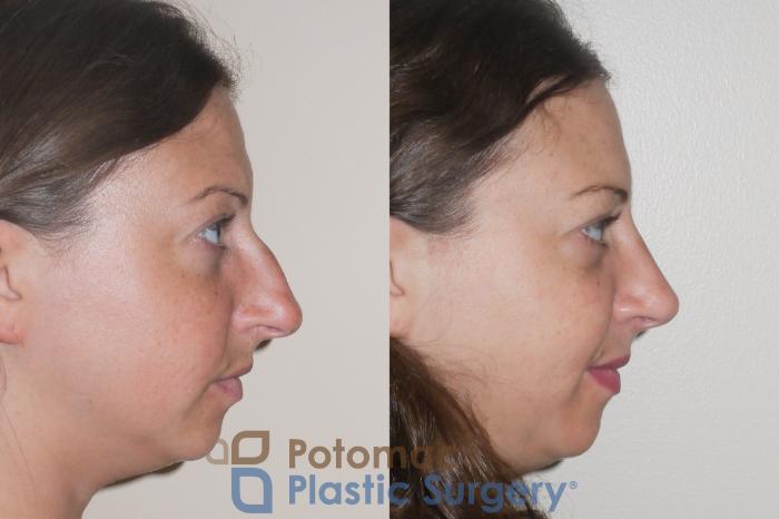 Before & After Rhinoplasty - Cosmetic Case 64 Right Side View in Washington DC & Arlington , DC