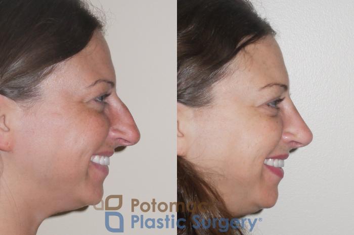 Before & After Rhinoplasty - Cosmetic Case 64 Right Side View #2 View in Washington DC & Arlington , DC
