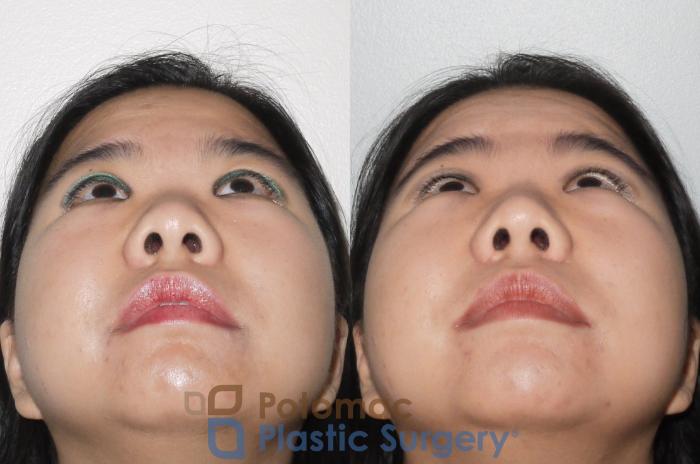 Before & After Rhinoplasty - Cosmetic Case 66 Below View in Washington DC & Arlington , DC
