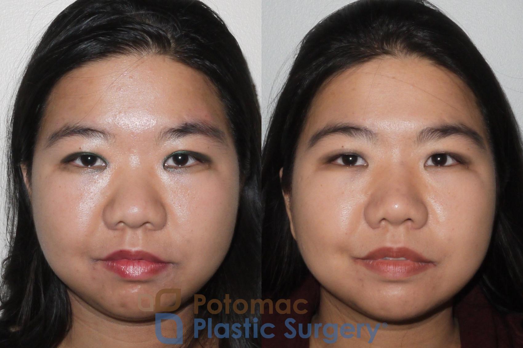Before & After Rhinoplasty - Cosmetic Case 66 Front View in Washington DC & Arlington , DC