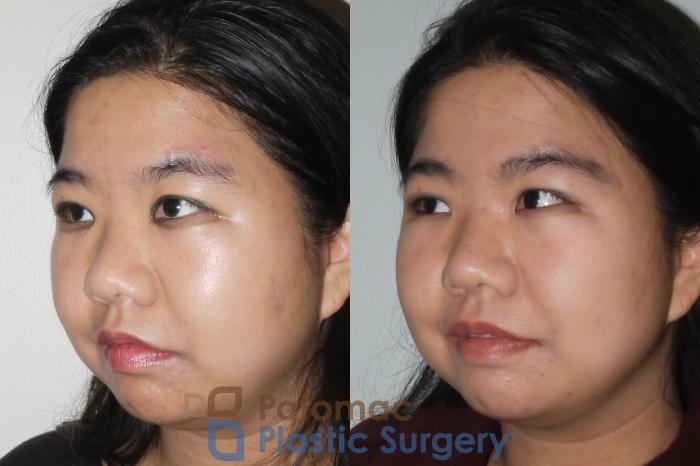 Before & After Rhinoplasty - Cosmetic Case 66 Left Oblique View in Washington DC & Arlington , DC
