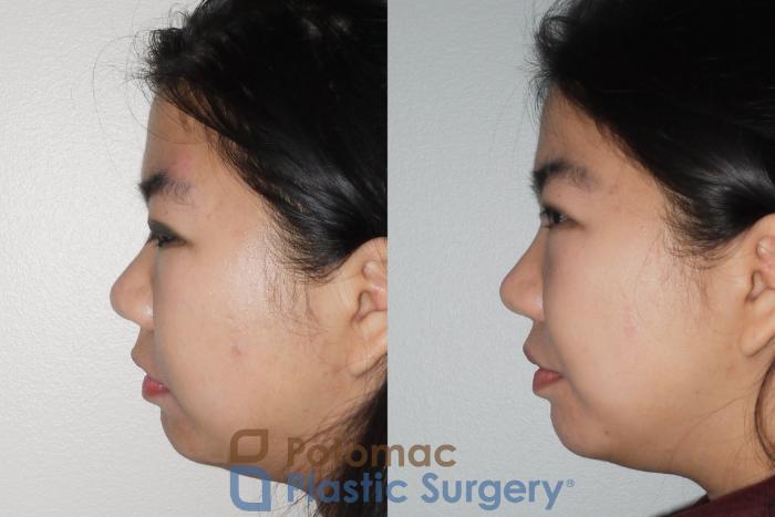 Before & After Rhinoplasty - Cosmetic Case 66 Left Side View in Washington DC & Arlington , DC