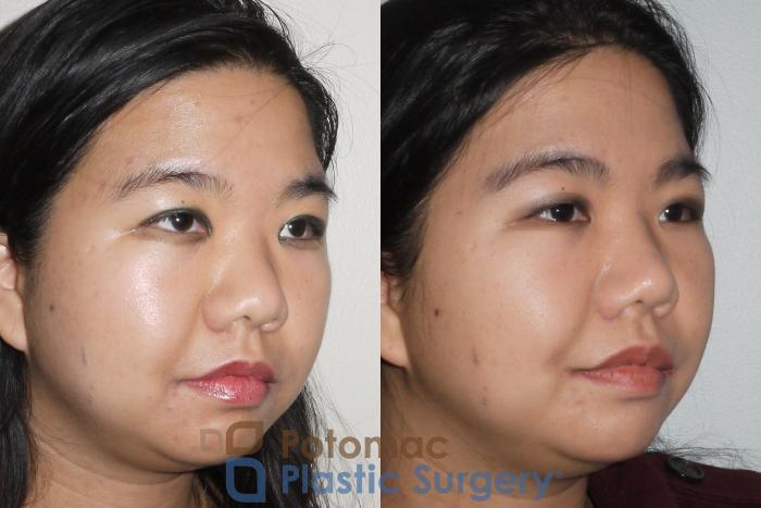 Before & After Rhinoplasty - Cosmetic Case 66 Right Oblique View in Washington DC & Arlington , DC