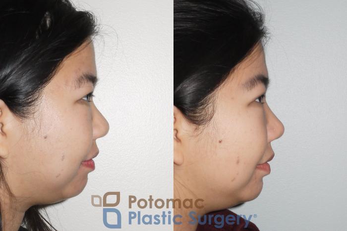 Before & After Rhinoplasty - Cosmetic Case 66 Right Side View in Washington DC & Arlington , DC