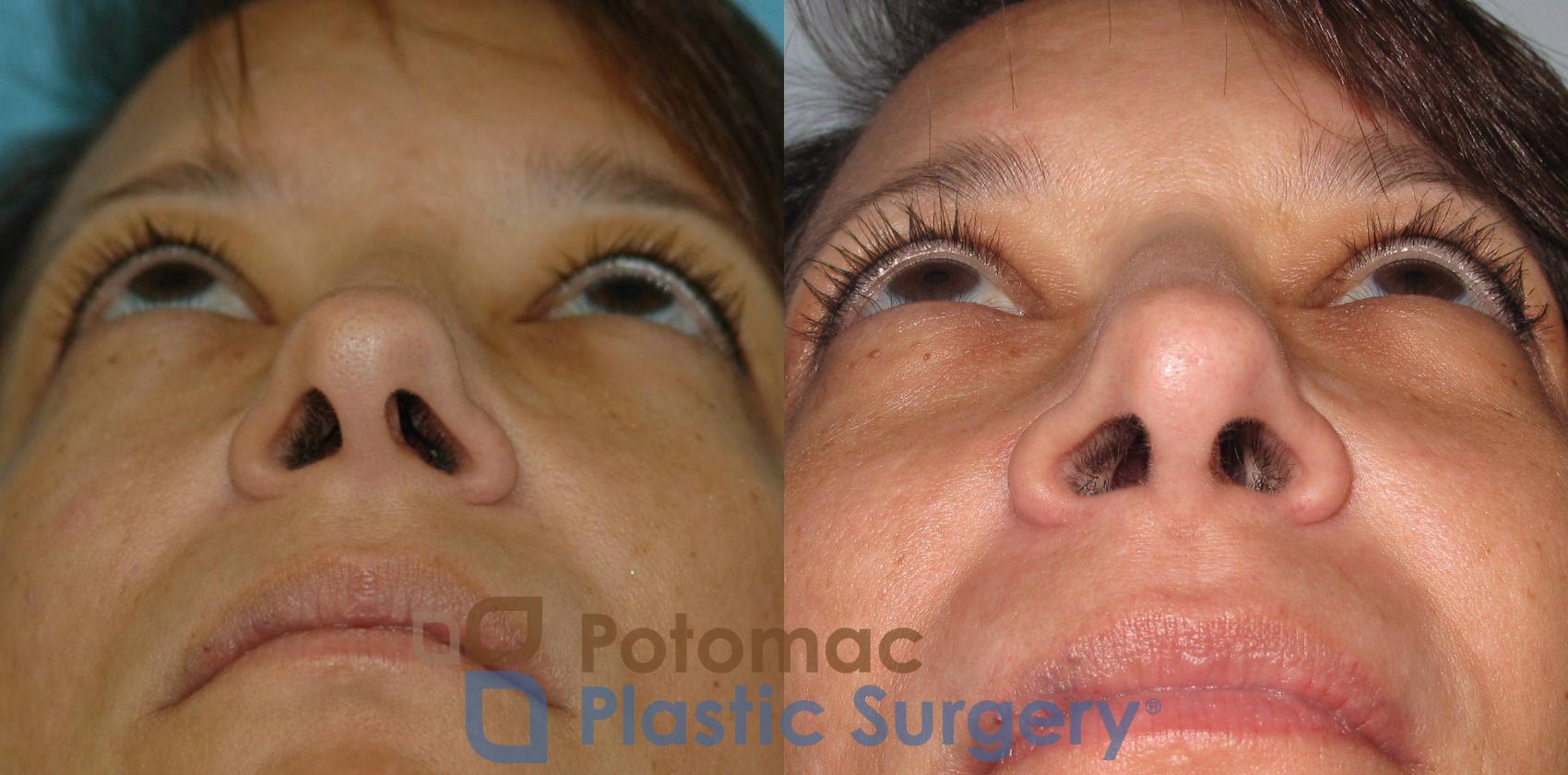 Before & After Blepharoplasty Case 7 Below View in Washington, DC