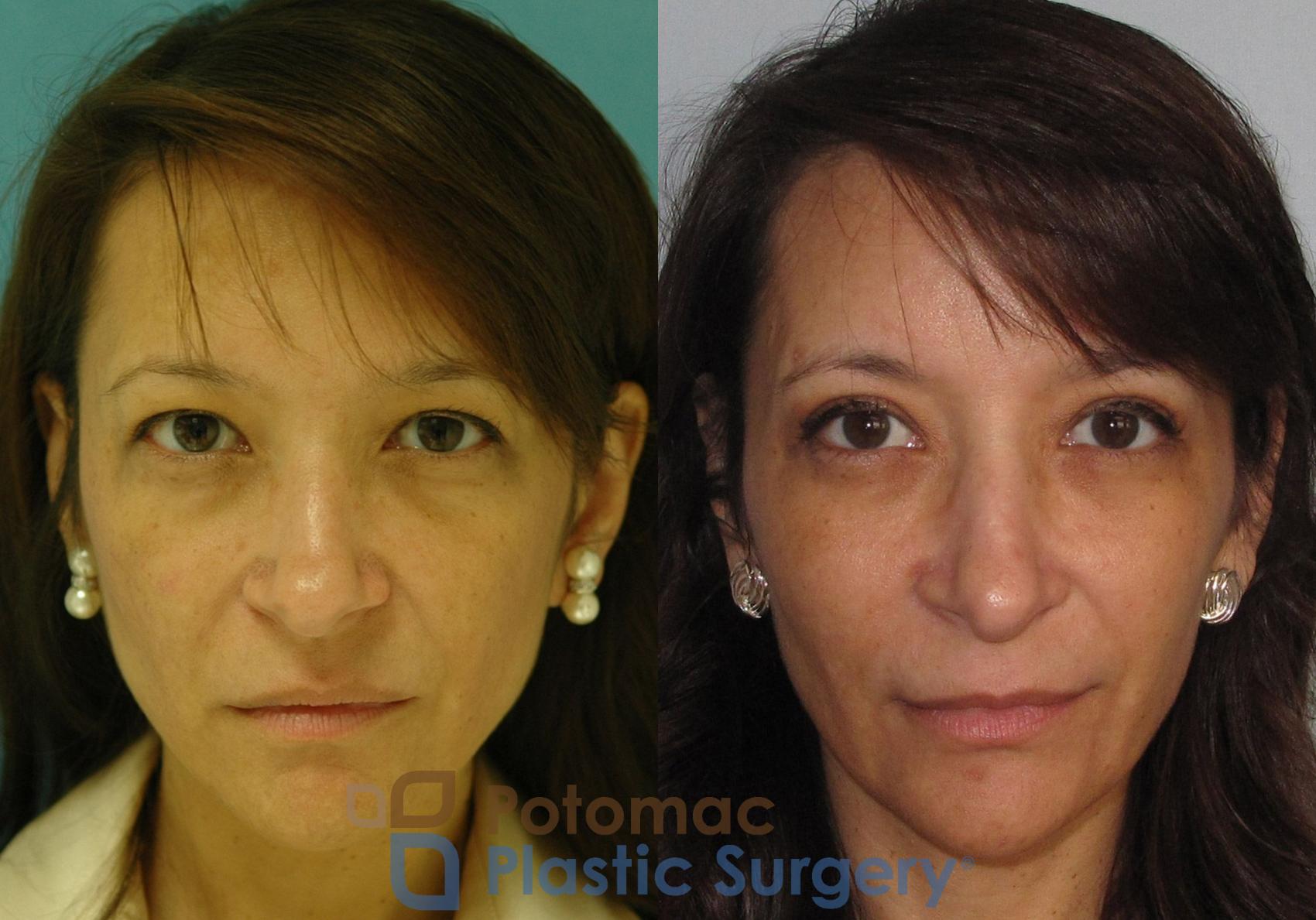 Before & After Blepharoplasty Case 7 Front View in Washington, DC