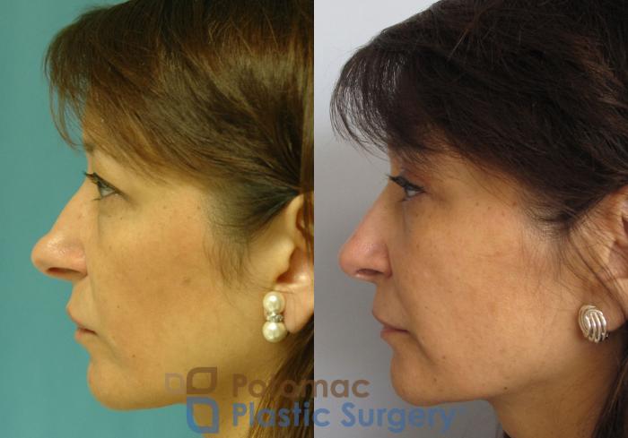 Before & After Rhinoplasty - Cosmetic Case 7 Left Side View in Washington DC & Arlington , DC