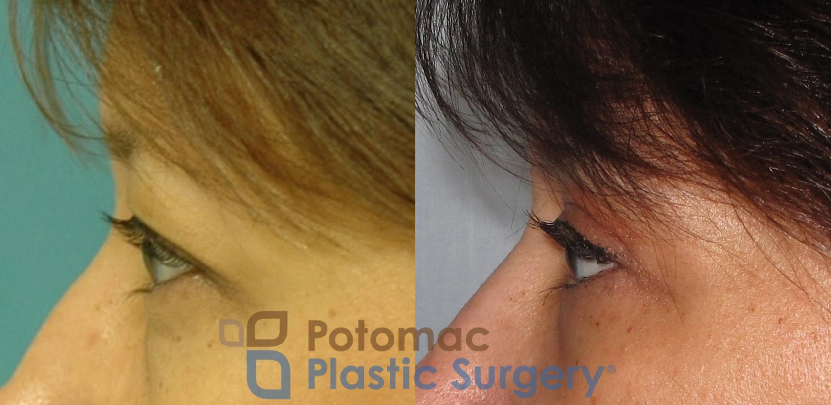 Before & After Blepharoplasty Case 7 Left Side View Close-Up #1 View in Washington, DC