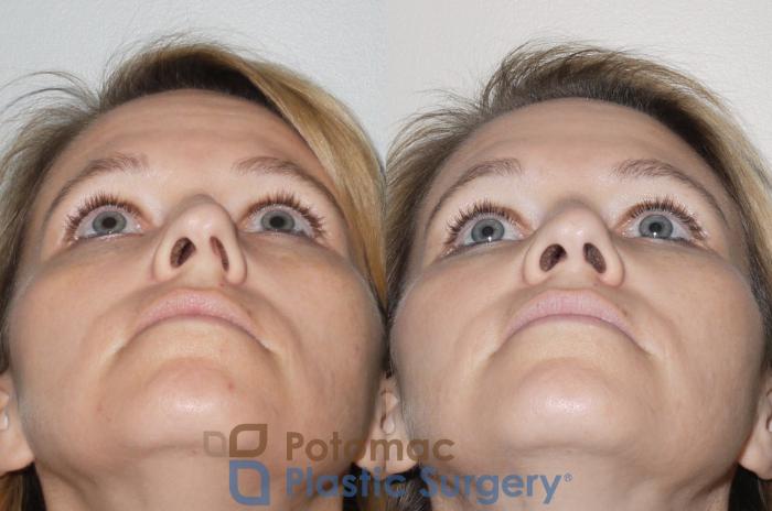 Before & After Rhinoplasty - Cosmetic Case 70 Below  View in Washington DC & Arlington , DC