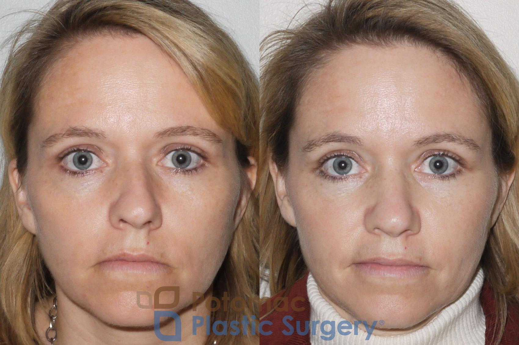 Before & After Rhinoplasty - Cosmetic Case 70 Front View in Washington, DC