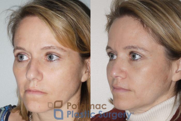 Before & After Rhinoplasty - Cosmetic Case 70 Left Oblique View in Washington DC & Arlington , DC