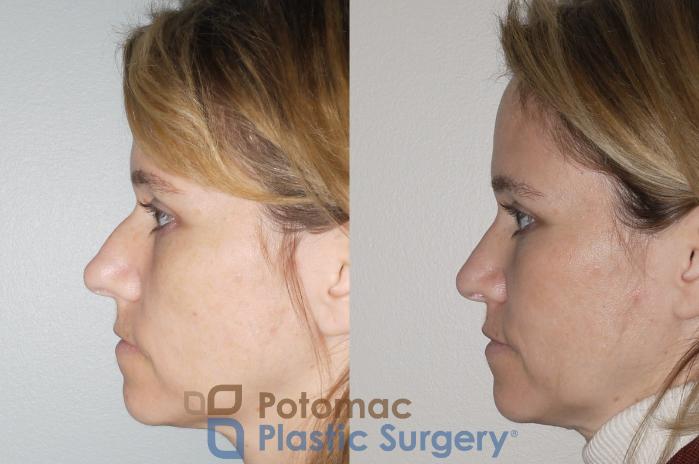 Before & After Rhinoplasty - Cosmetic Case 70 Left Side View in Washington DC & Arlington , DC