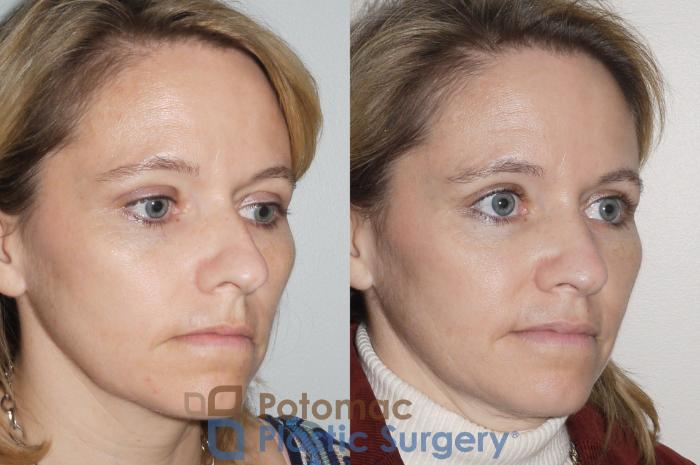 Before & After Rhinoplasty - Cosmetic Case 70 Right Oblique View in Washington DC & Arlington , DC