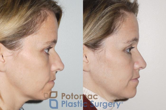 Before & After Rhinoplasty - Medical Case 70 Right Side View View in Washington DC & Arlington , DC