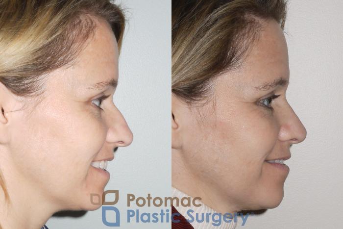 Before & After Rhinoplasty - Medical Case 70 Right View #2 View in Washington DC & Arlington , DC