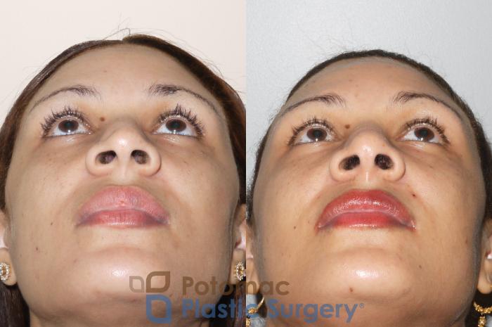 Before & After Rhinoplasty - Cosmetic Case 72 Below View in Washington, DC
