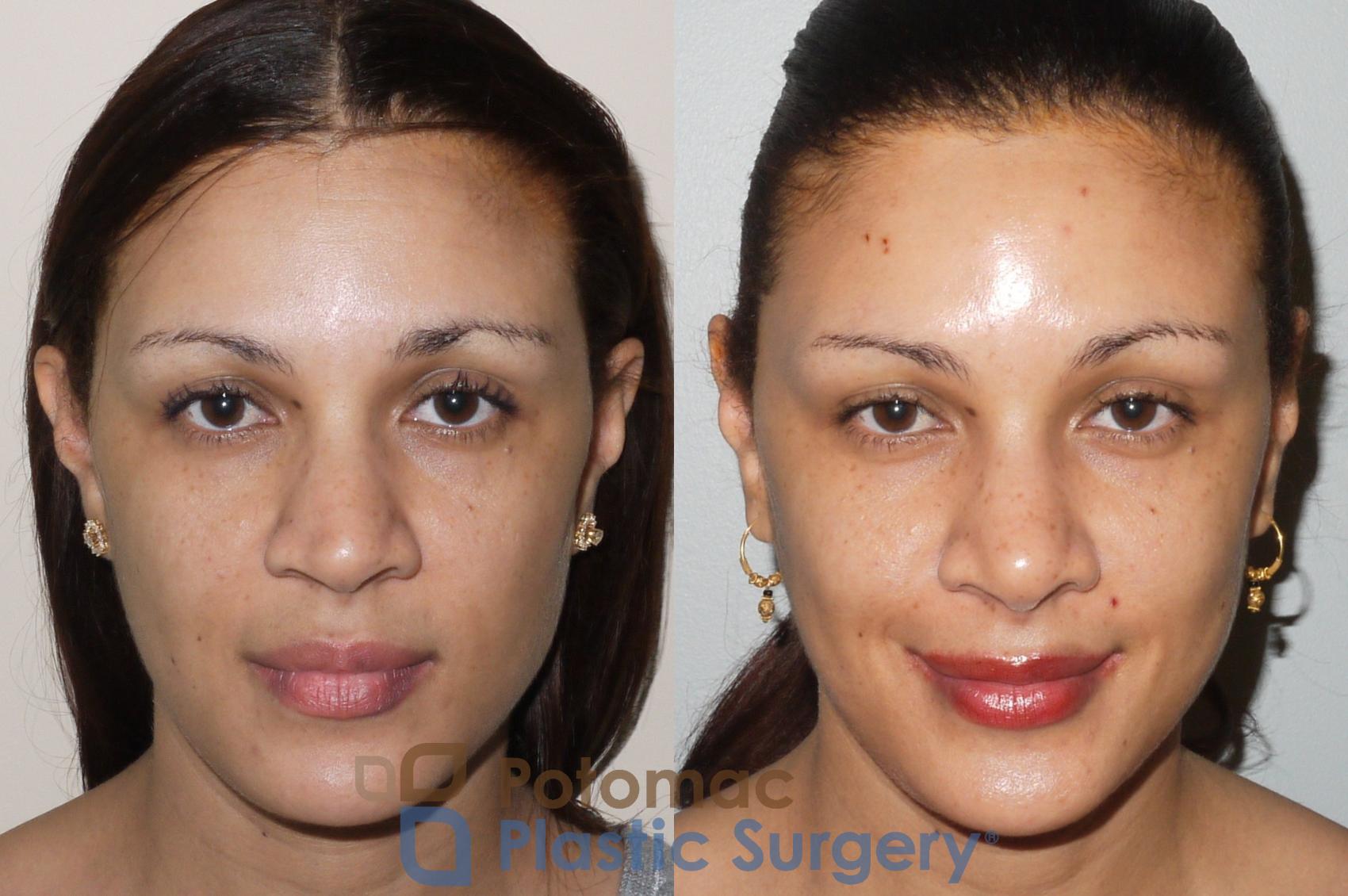 Before & After Rhinoplasty - Cosmetic Case 72 Front View in Washington, DC