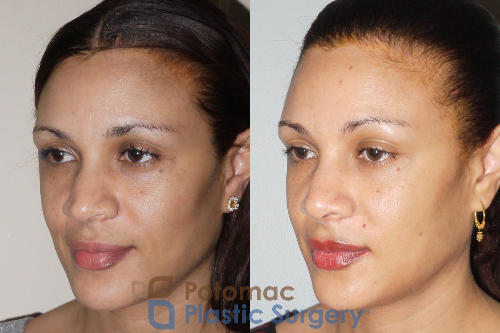 Before & After Rhinoplasty - Cosmetic Case 72 Left Oblique View in Washington, DC