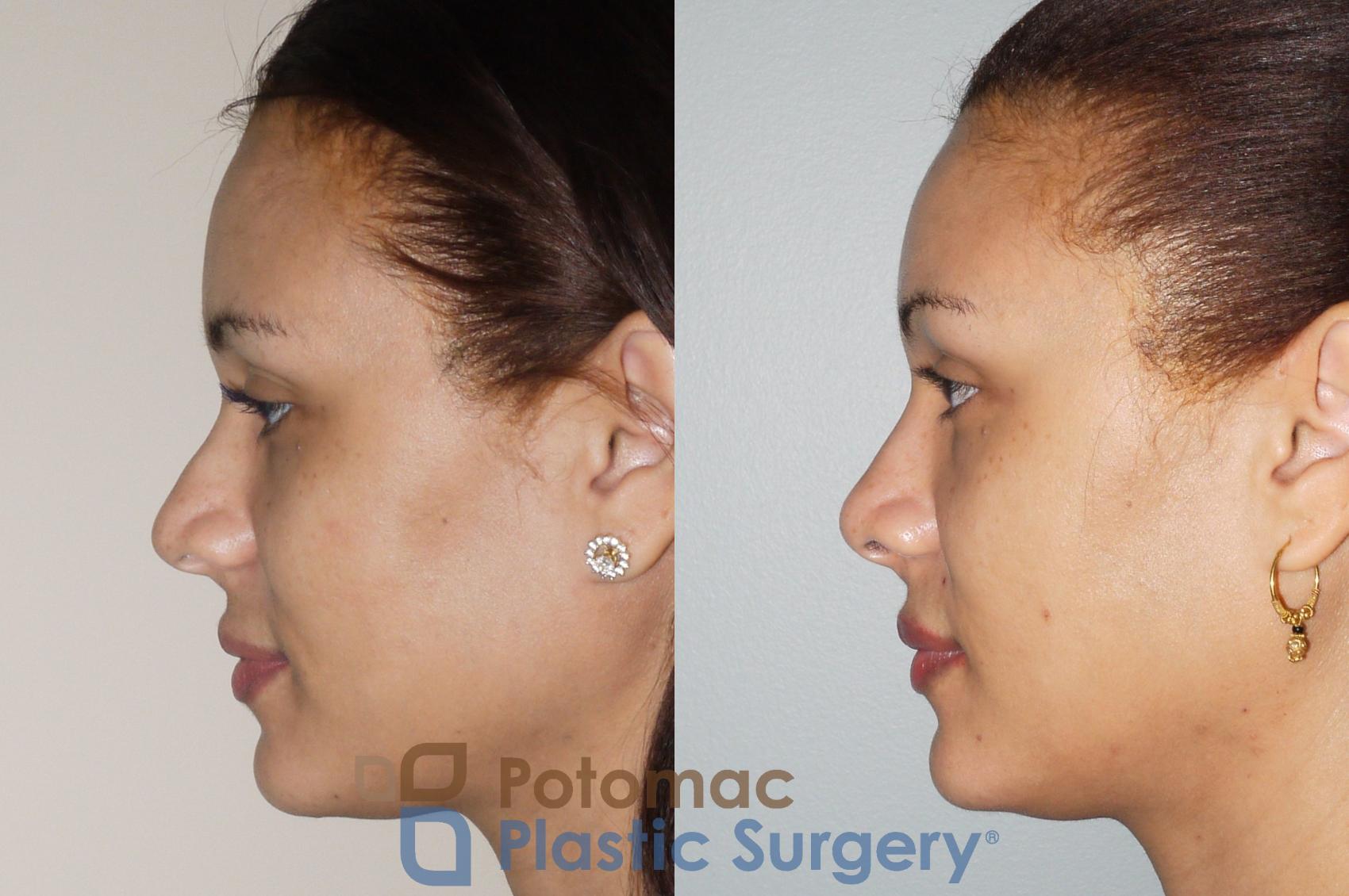 Before & After Rhinoplasty - Cosmetic Case 72 Left Side View in Washington, DC