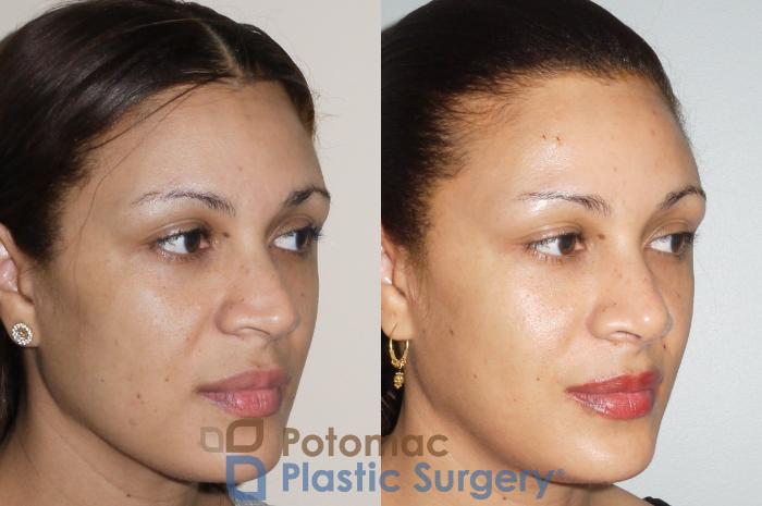 Before & After Rhinoplasty - Cosmetic Case 72 Right Oblique View in Washington, DC