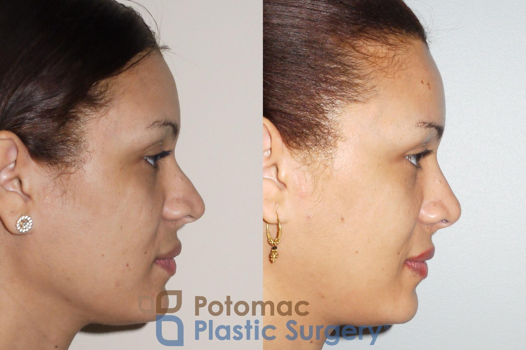 Before & After Rhinoplasty - Cosmetic Case 72 Right Side View in Washington, DC