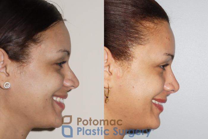 Before & After Rhinoplasty - Cosmetic Case 72 Right Side View #2 View in Washington, DC