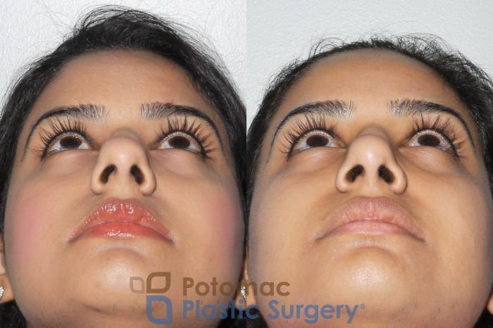 Before & After Rhinoplasty - Medical Case 77 Bottom View in Washington DC & Arlington , DC