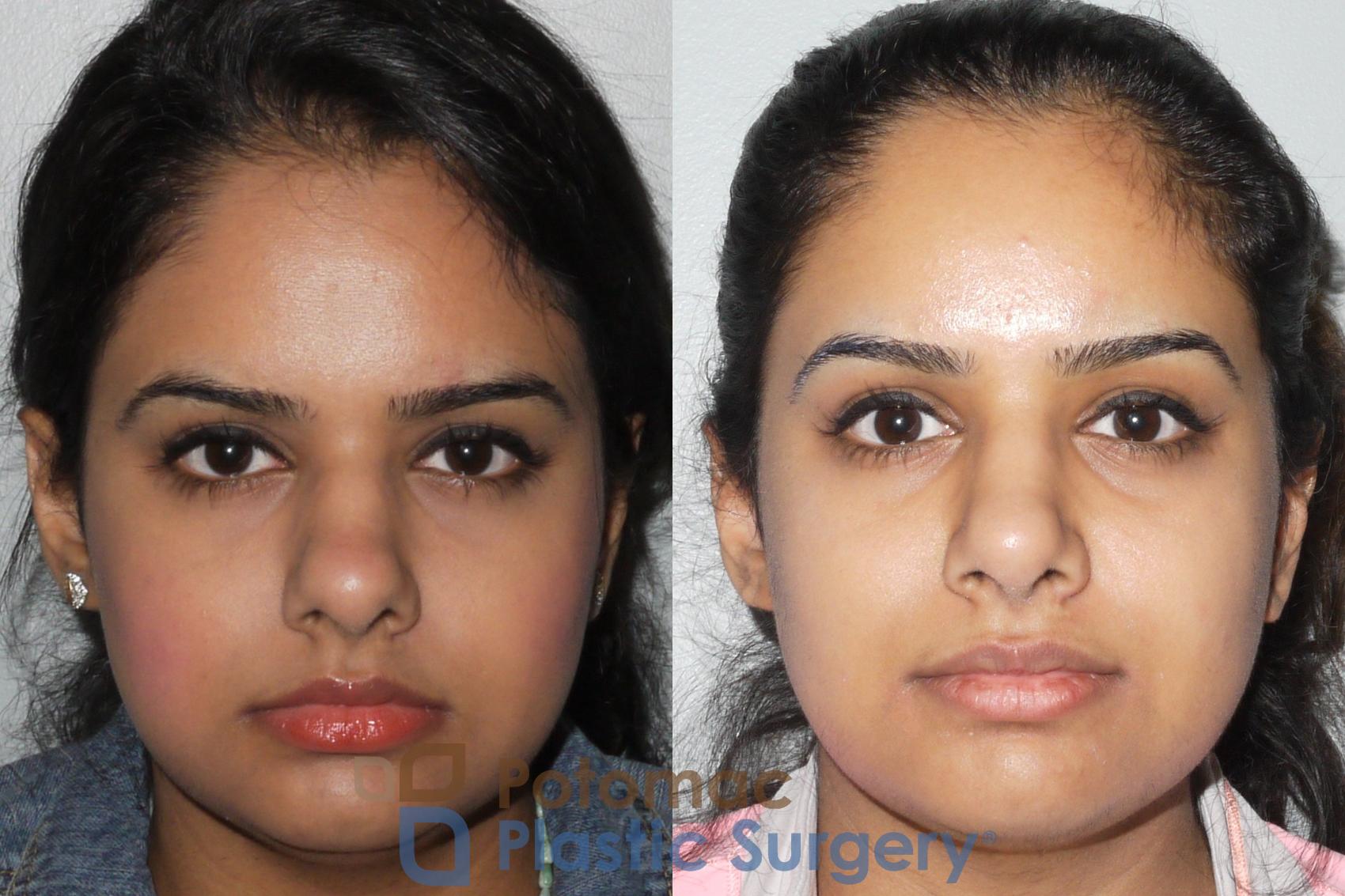 Before & After Rhinoplasty - Medical Case 77 Front View in Washington DC & Arlington , DC