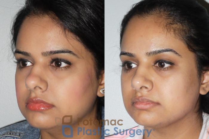 Before & After Rhinoplasty - Cosmetic Case 77 Left Oblique View in Washington DC & Arlington , DC