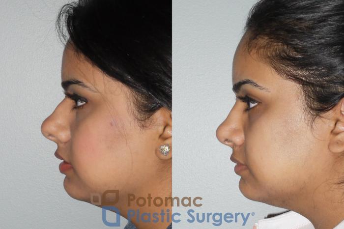 Before & After Rhinoplasty - Cosmetic Case 77 Left Side View in Washington DC & Arlington , DC