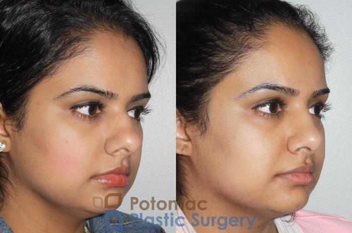 Before & After Rhinoplasty - Medical Case 77 Right Oblique View in Washington DC & Arlington , DC