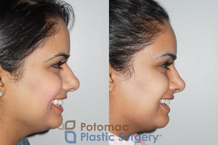 Before & After Rhinoplasty - Medical Case 77 Right Side - Smiling View in Washington DC & Arlington , DC