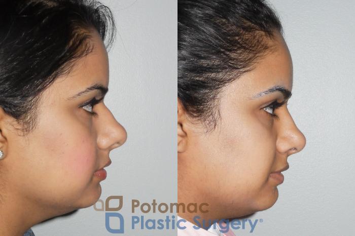Before & After Rhinoplasty - Medical Case 77 Right Side View in Washington DC & Arlington , DC