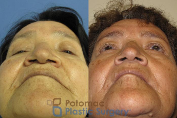 Before & After Rhinoplasty - Medical Case 8 Below View in Washington DC & Arlington , DC