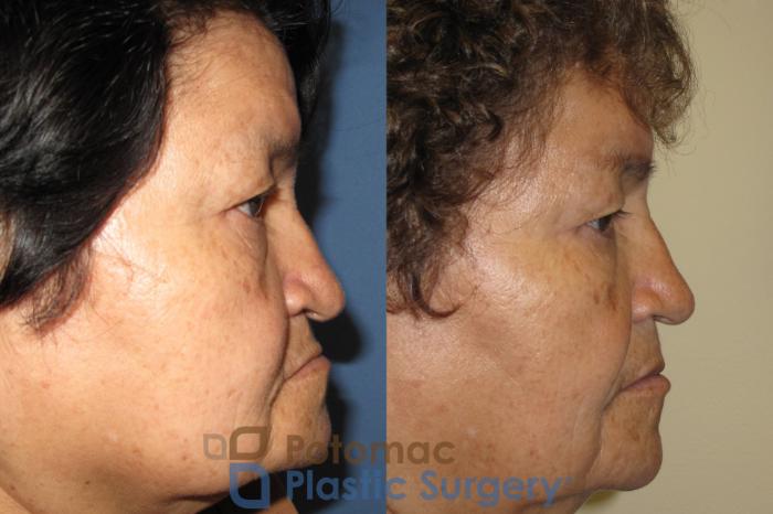 Before & After Rhinoplasty - Cosmetic Case 8 Right Side View in Washington, DC