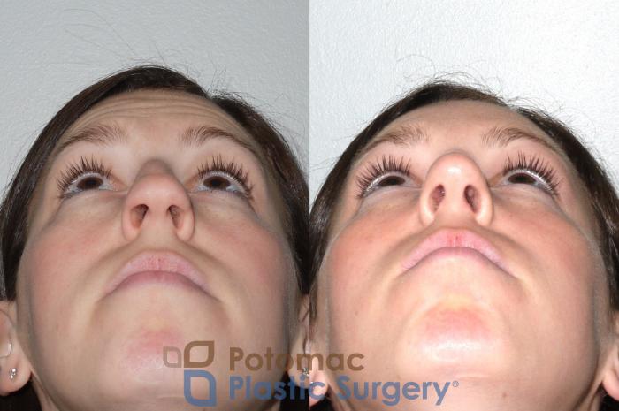 Before & After Rhinoplasty - Cosmetic Case 80 Below View in Washington DC & Arlington , DC