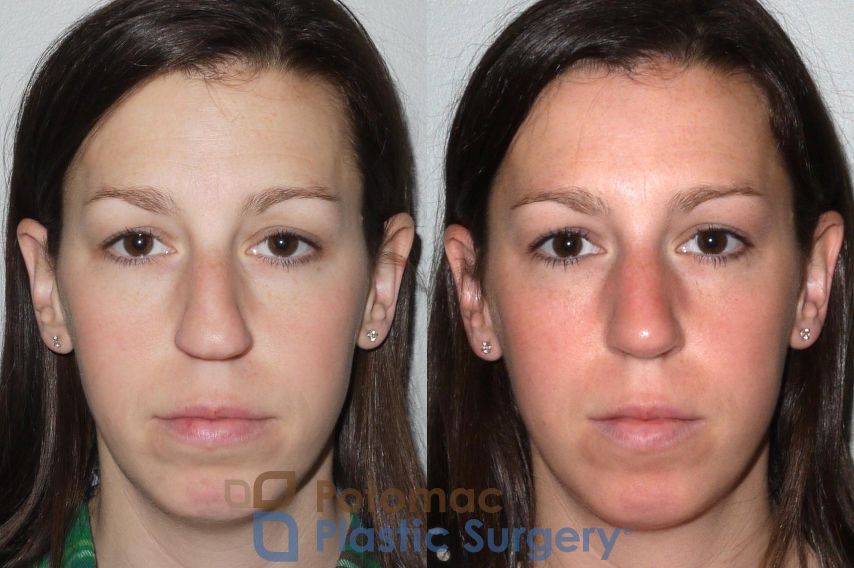 Before & After Rhinoplasty - Cosmetic Case 80 Front View in Washington DC & Arlington , DC