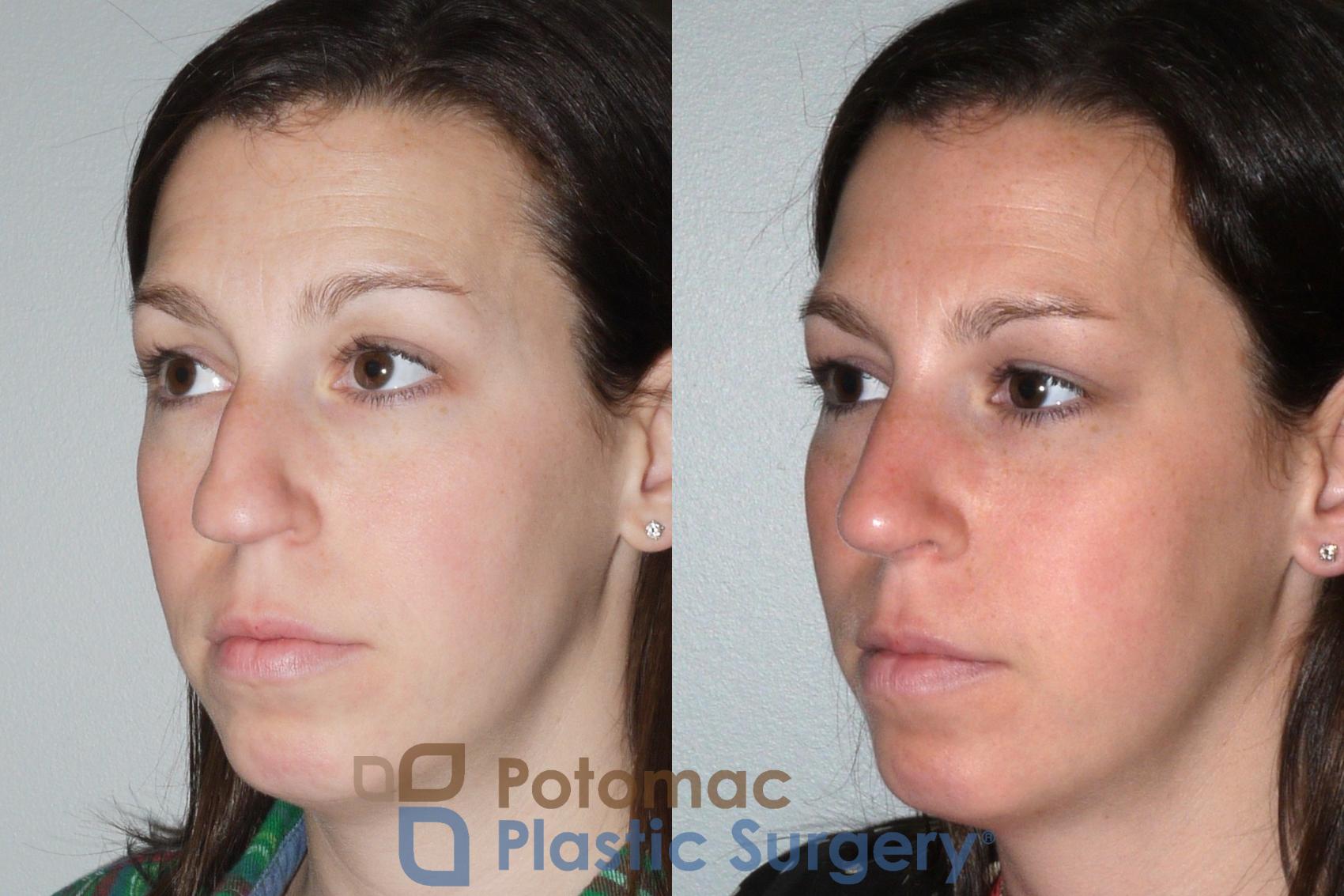 Before & After Rhinoplasty - Cosmetic Case 80 Left Oblique View in Washington DC & Arlington , DC