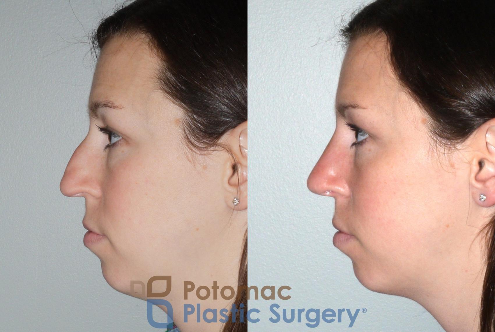 Before & After Rhinoplasty - Cosmetic Case 80 Left Side View in Washington DC & Arlington , DC
