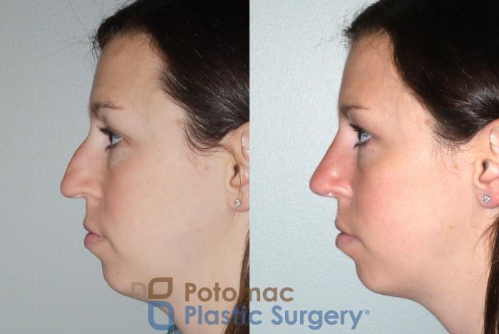 Before & After Rhinoplasty - Medical Case 80 Left Side View in Washington DC & Arlington , DC