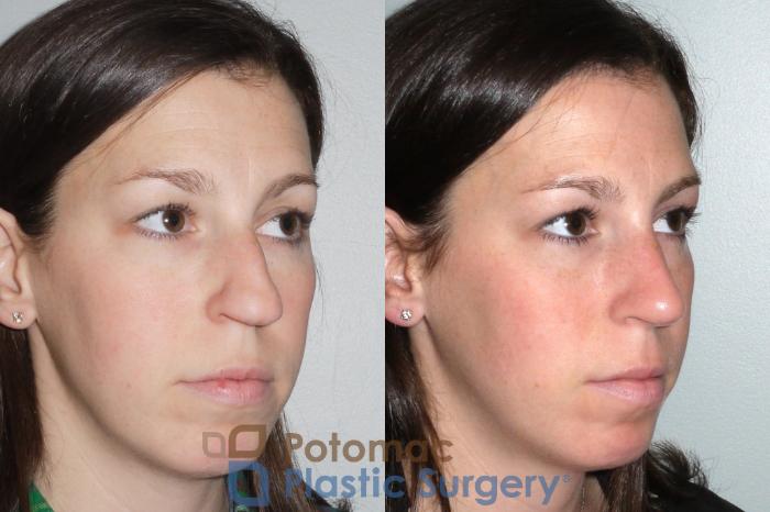 Before & After Rhinoplasty - Cosmetic Case 80 Right Oblique View in Washington DC & Arlington , DC