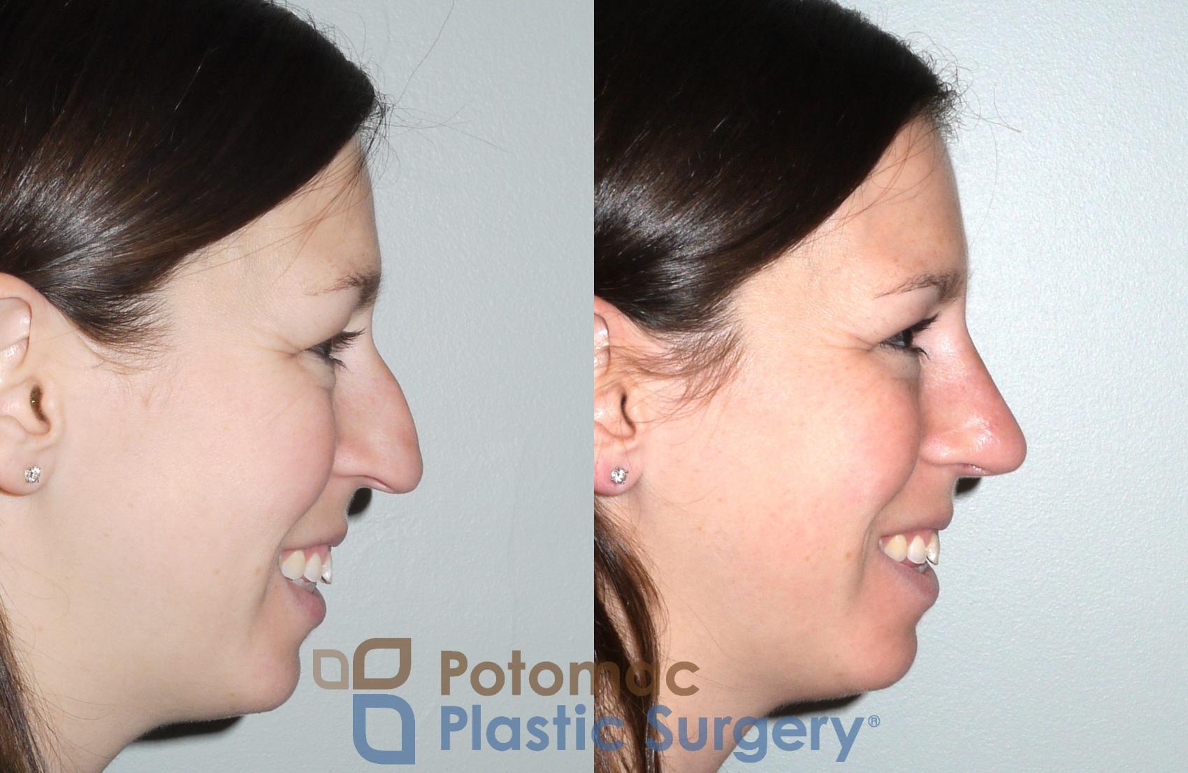 Before & After Rhinoplasty - Medical Case 80 Right Side View in Washington DC & Arlington , DC