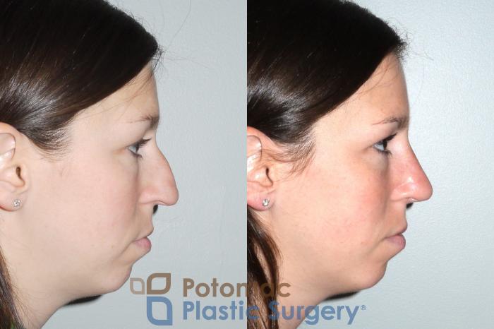 Before & After Rhinoplasty - Cosmetic Case 80 Right View #2 View in Washington DC & Arlington , DC
