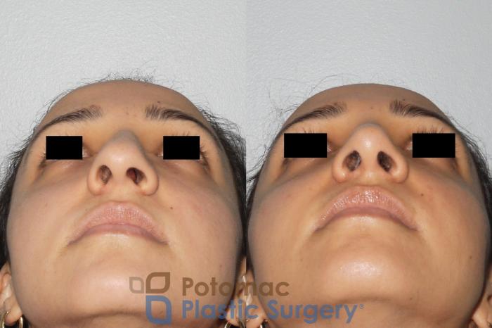 Before & After Rhinoplasty - Medical Case 82 Below View in Washington DC & Arlington , DC