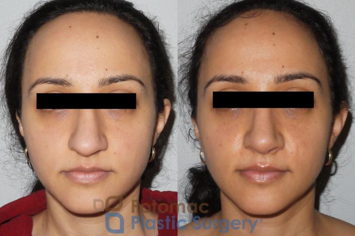 Before & After Rhinoplasty - Cosmetic Case 82 Front View in Washington DC & Arlington , DC